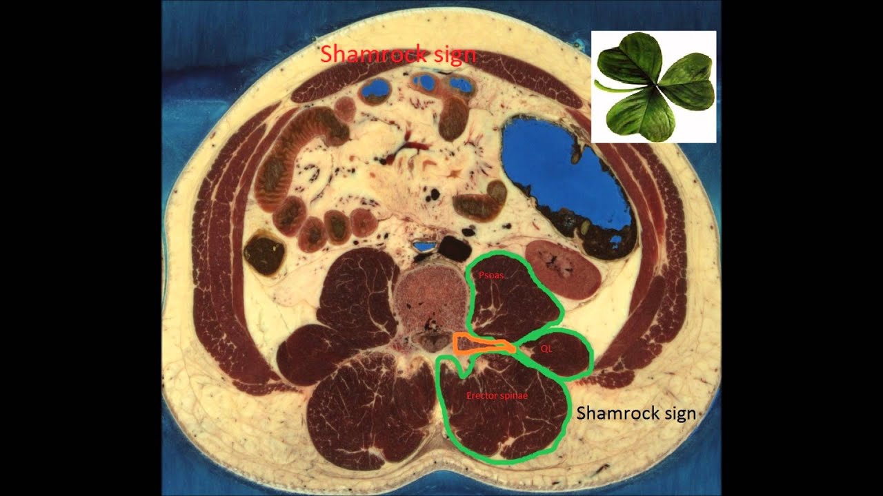 Ultrasound guided Quadratus Lumborum Block (QLB-1)