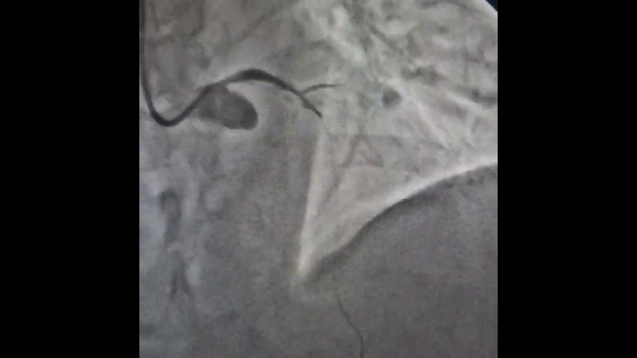 LM to LAD with heavy calcification | Complex PTCA + Stenting | Dr. Rajat Rawat | Agra Heart Centre