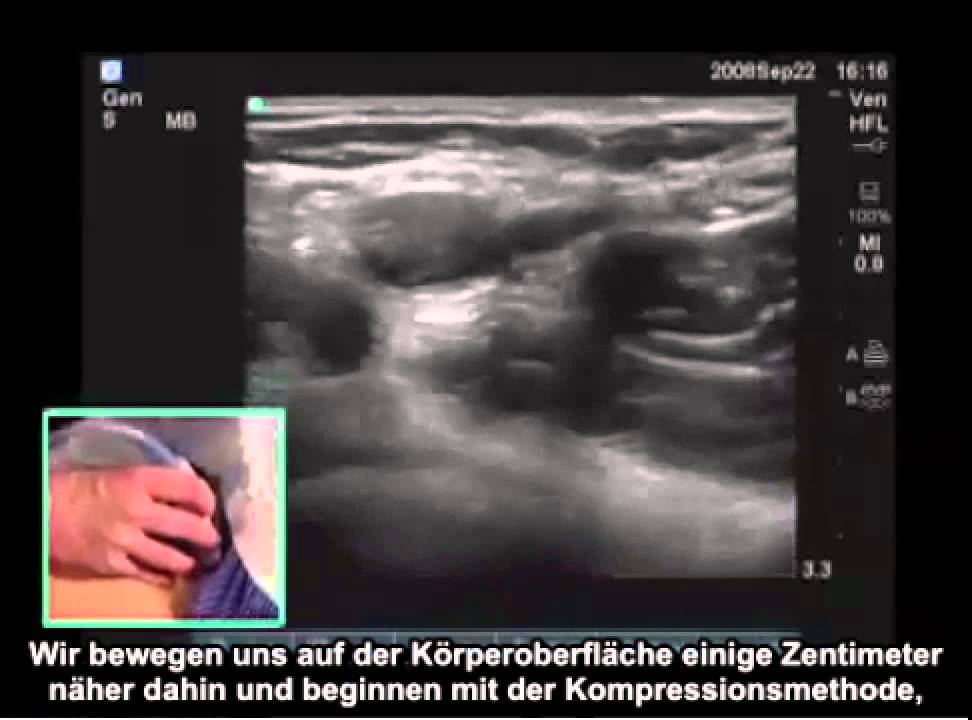 Anleitung: Tiefe Venenthrombose der unteren Extremitäten mit Ultraschall