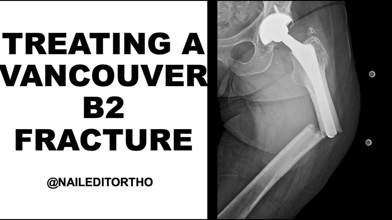 Treating a Vancouver B2 Periprosthetic Fracture