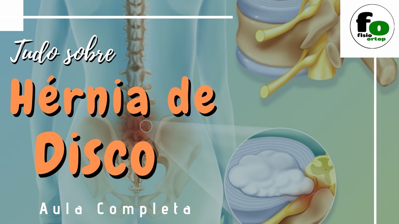 Tudo sobre Hernia de disco | Aula Completa