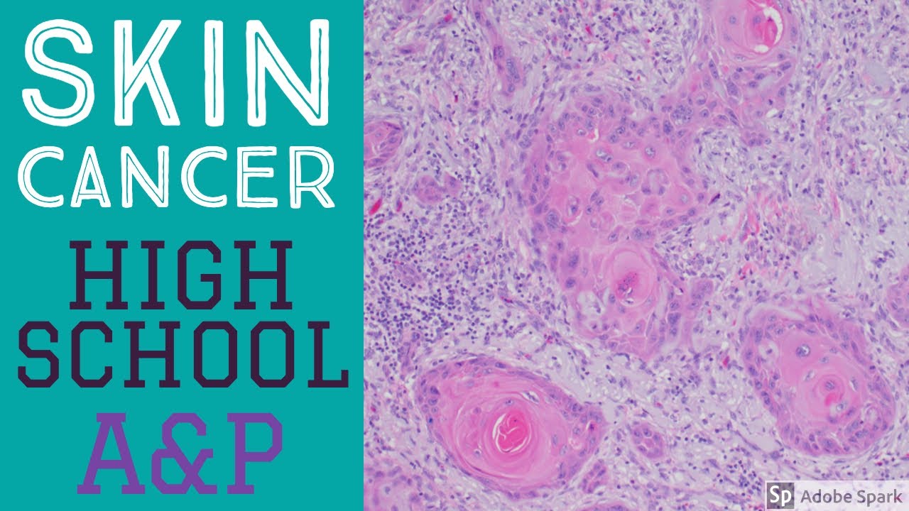 What does skin cancer look like under the microscope? Skin cancer explained in simple terms