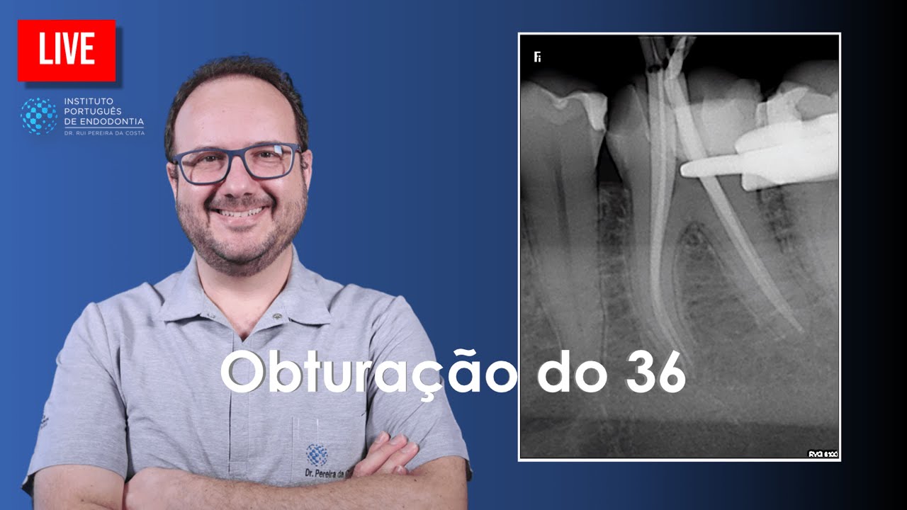 🔴 Obturação do 36 com Técnica de Onda Contínua de Obturação