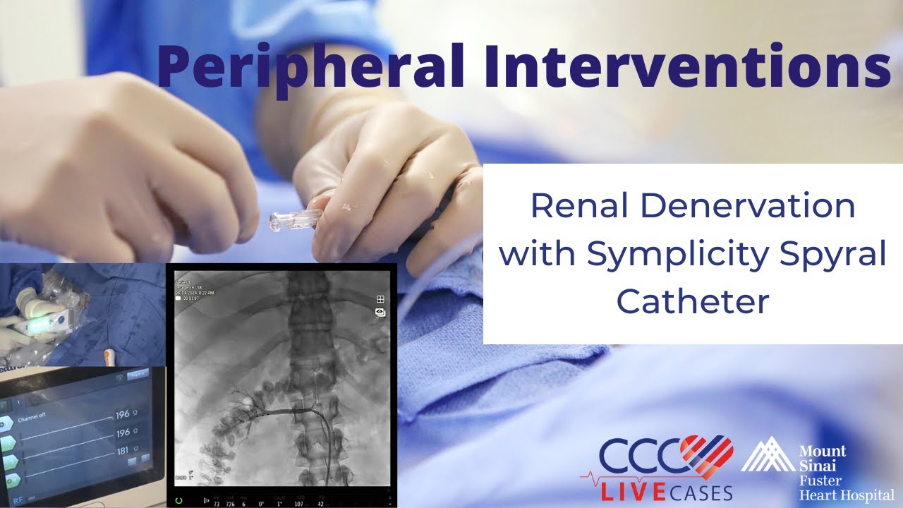 Renal Denervation with Symplicity Spyral Catheter - August 14th 2024
