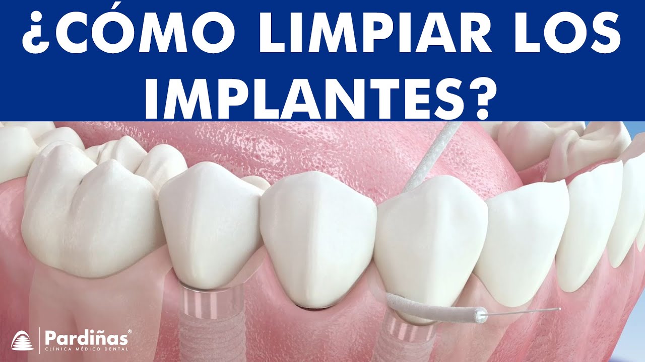 Seda dental e Irrigador - C&oacute;mo limpiar pr&oacute;tesis e implantes &copy;