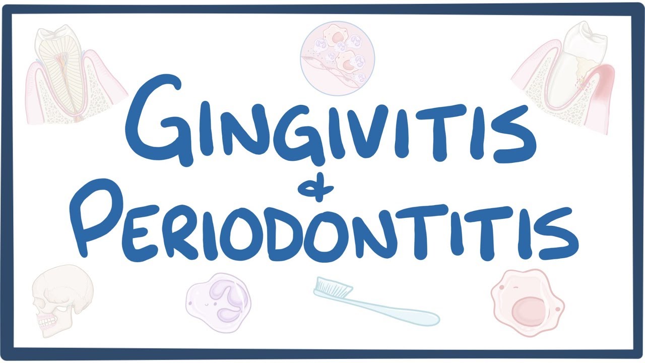 Gingivitis and periodontitis - causes, symptoms, diagnosis, treatment, pathology
