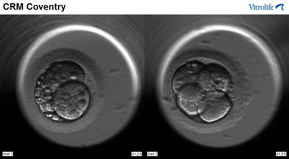 IVF - Embryoscope - 2 Embryos
