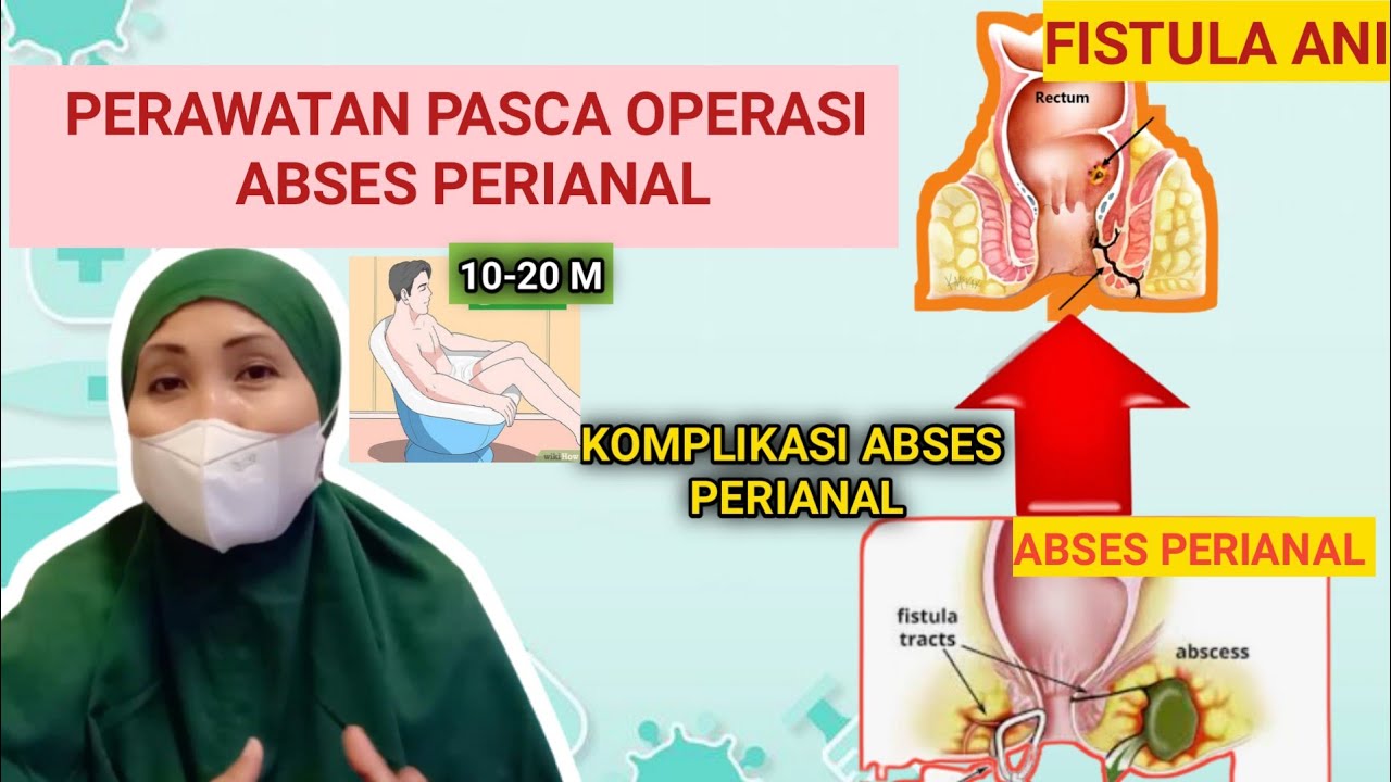 PERAWATAN PASCA OPERASI ABSES PERIANAL - PANTANGAN PASCA OPERASI