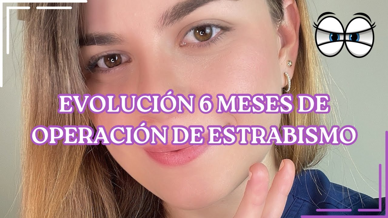 Que ha pasado después de 6 meses de mi operación de ESTRABISMO ✅👀