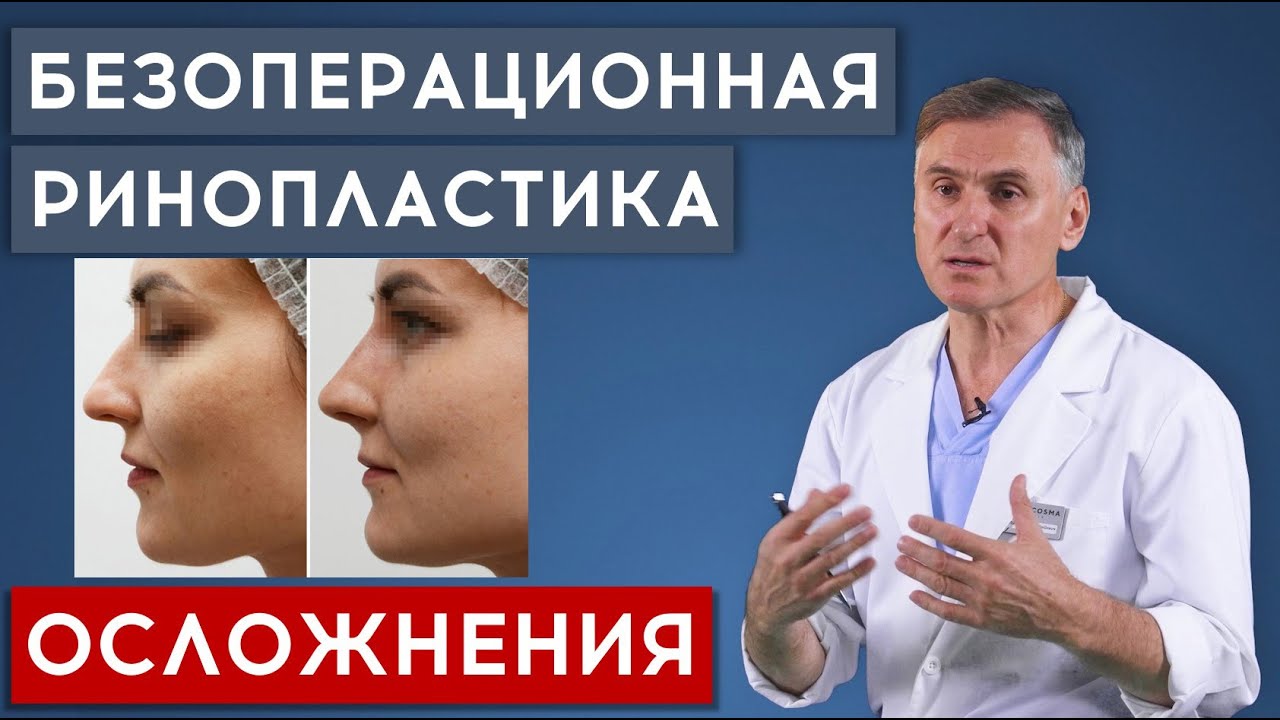 БЕЗОПЕРАЦИОННАЯ РИНОПЛАСТИКА 🆘 ОСЛОЖНЕНИЯ и как избежать
