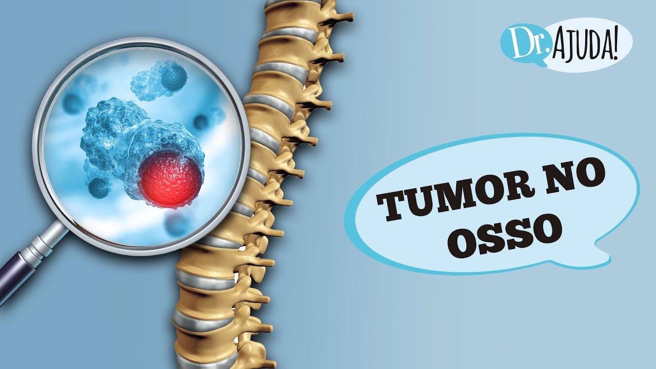 TUMOR NO OSSO: O QUE PODE SER? SINTOMAS, DIAGNÓSTICO E TRATAMENTO