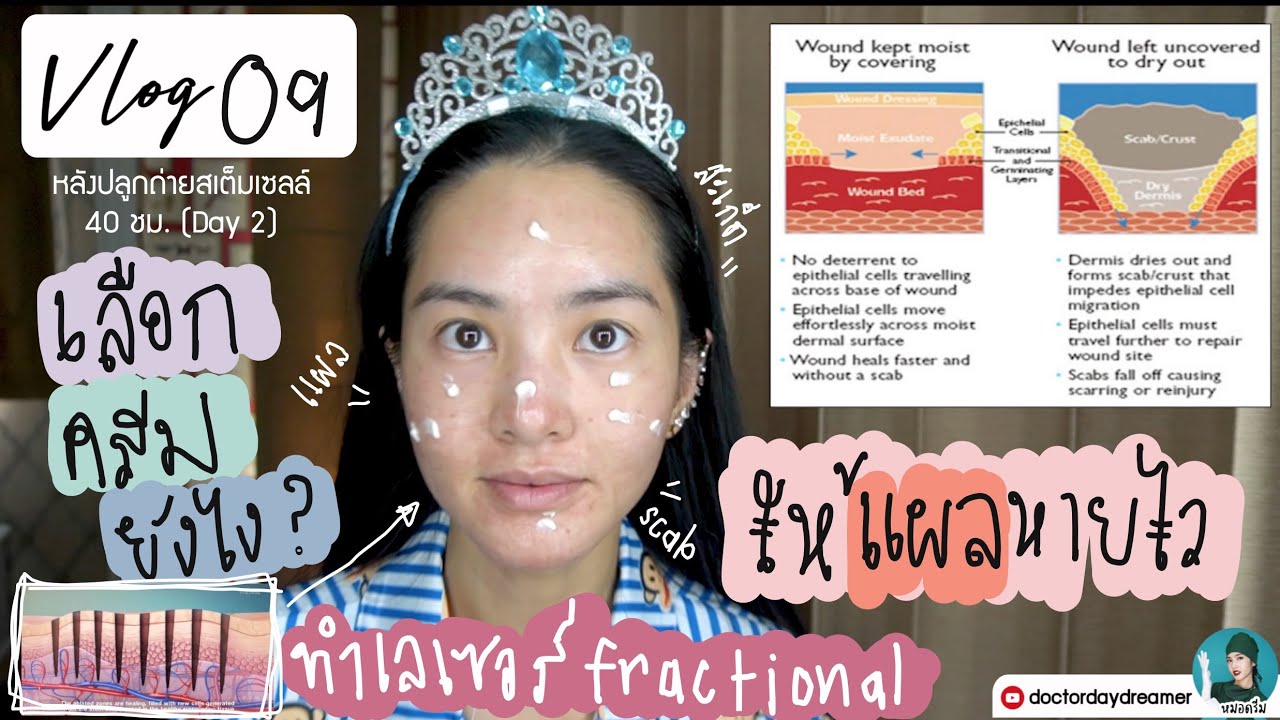 vlog09 เลือกครีมยังไงให้แผลเลเซอร์ #หลุมสิว หายไว?+ดูผิวหลังฉีด #สเต็มเซลล์ 2วัน| DOCTOR DAYDREAMER
