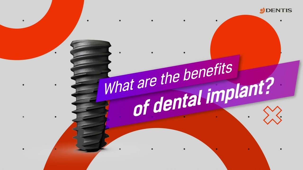 Beneficios de los implantes dentales para los pacientes.