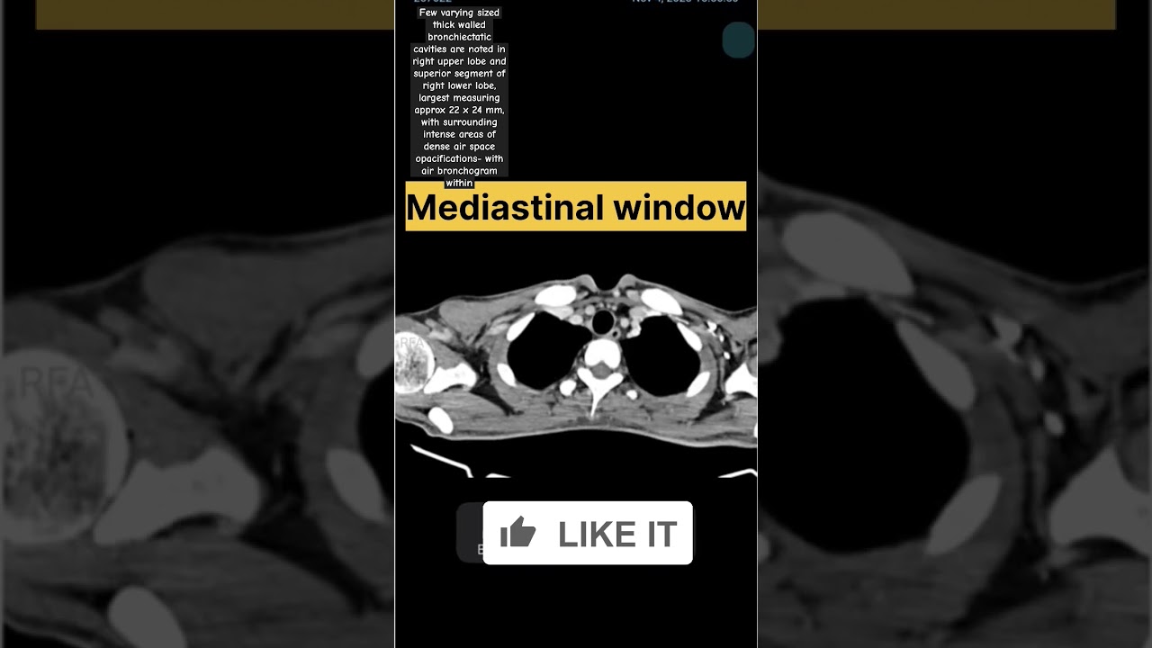 Pulmonary kochs #kochs #tb #infaction #lung infaction #smoker #cough #fever #ctscan #new