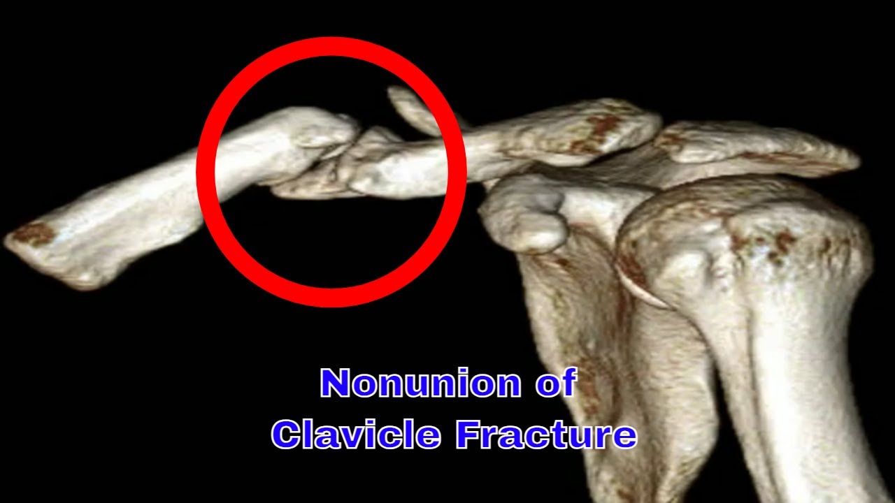 Nonunion of Clavicle Fracture: Causes, Symptoms, and Treatment Options 쇄골 골절 불유합 : 원인, 증상 및 치료 방법