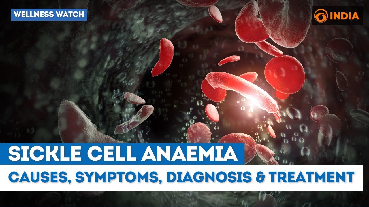 Sickle Cell Anaemia: Causes, symptoms, diagnosis & treatment | Wellness Watch