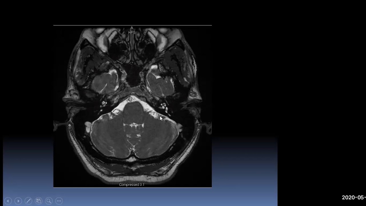 Advanced temporal bone imaging: interactive session - Dr. Ashkan Monfared