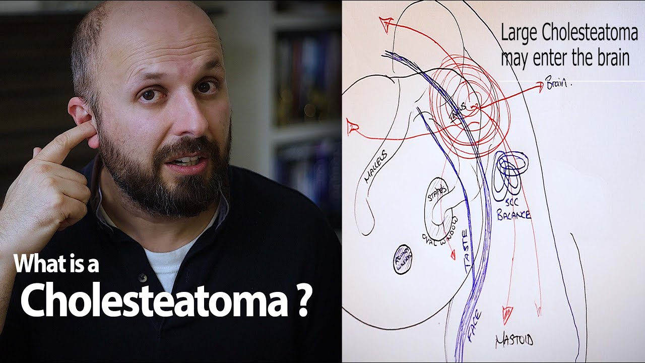 The dangerous cause of ear infections that no one knows about.