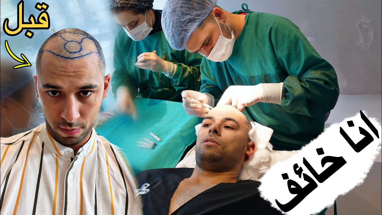واجهت خوف عملية زراعة الشعر بنفسي / تركيا