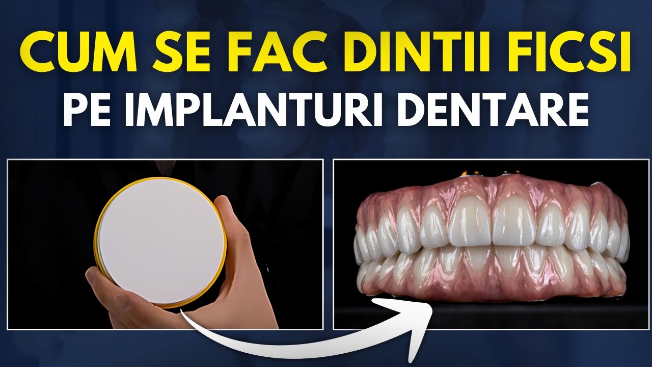 Cum se fac Dintii Ficsi pe Implanturi - TOT PROCESUL