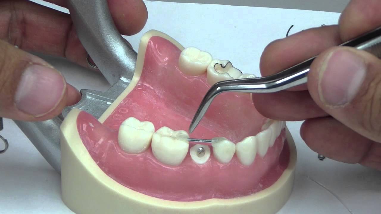 Premolar Forced Eruption/Extrusion