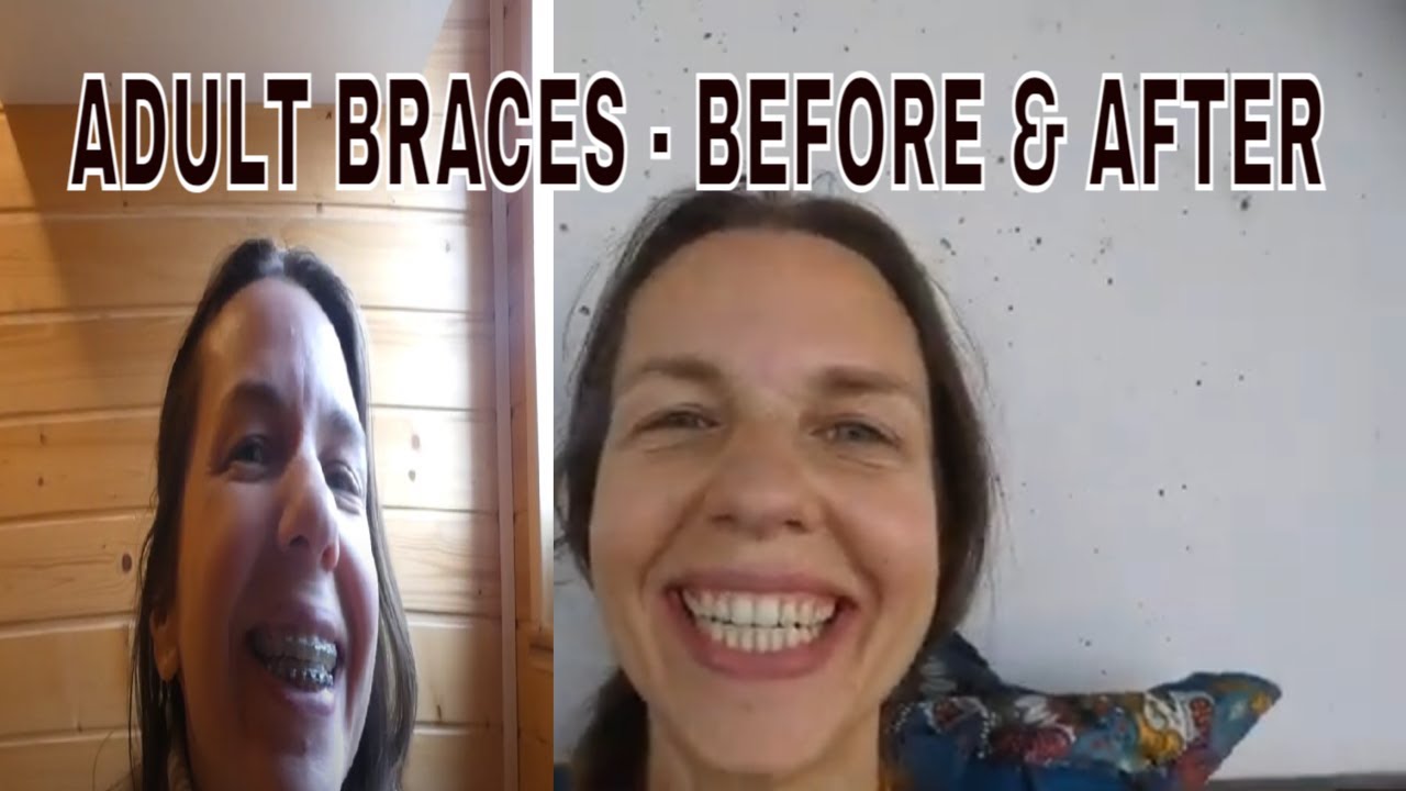 Braces at 40 years old! - Before & After| Transformation!