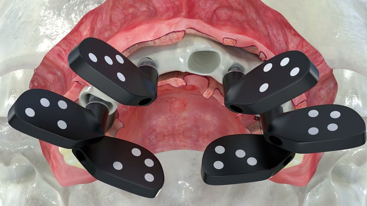 Full-Arch Maxillary FP1 Rehabilitation with PIC system | Dr. David Lara Precision Protocol
