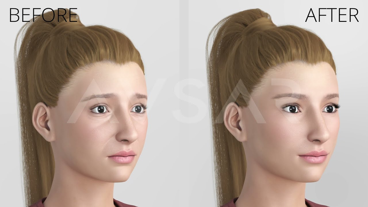 Yakup Avsar Charm lift, Extended Vertical Endoscopic face lift without scar supported with Avsarm