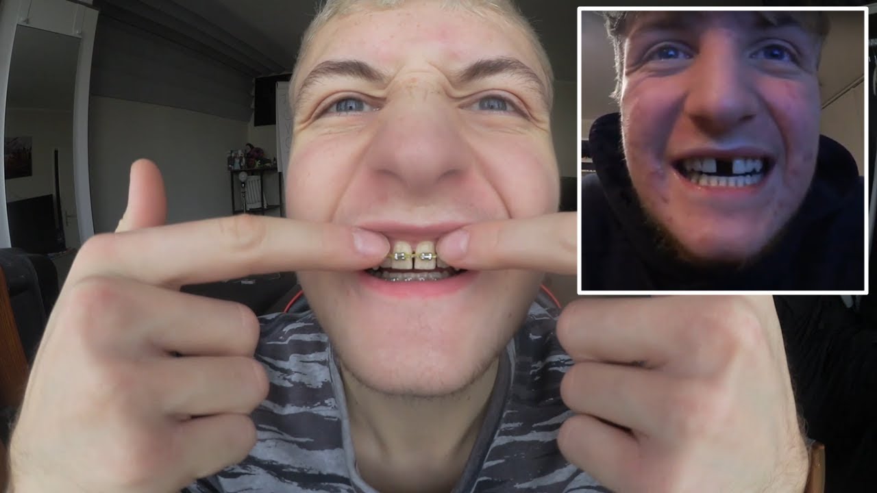 1 JAHR nach GNE/KIEFER OP! Zahnlücke, Update, Erfahrung & Tipps!