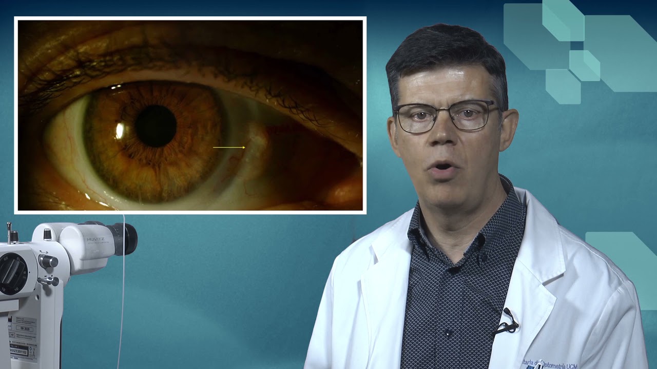 8 BIOMICROSCOPIA: ILUMINACION TANGENCIAL