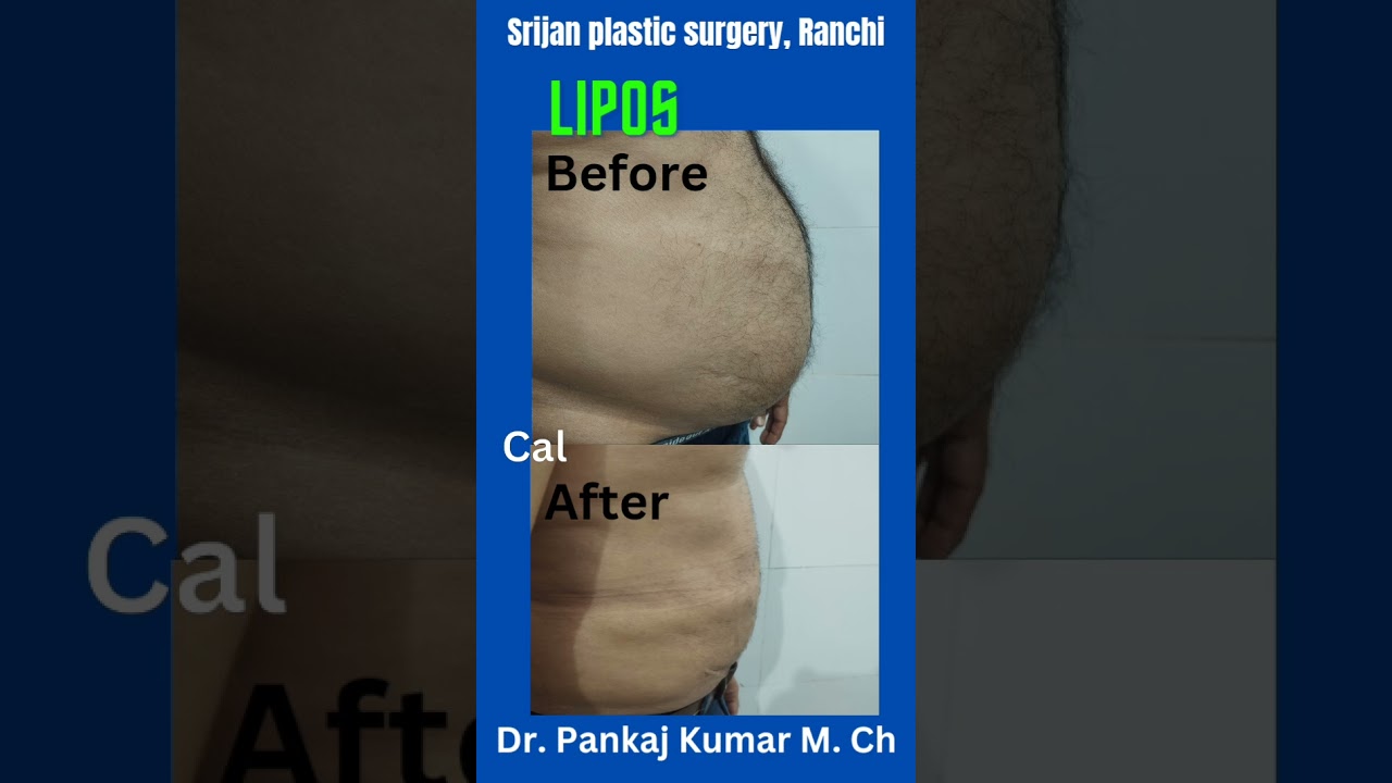 Liposuction in Ranchi| Fat removal in Ranchi| #shorts #youtubeshorts  #liposuction