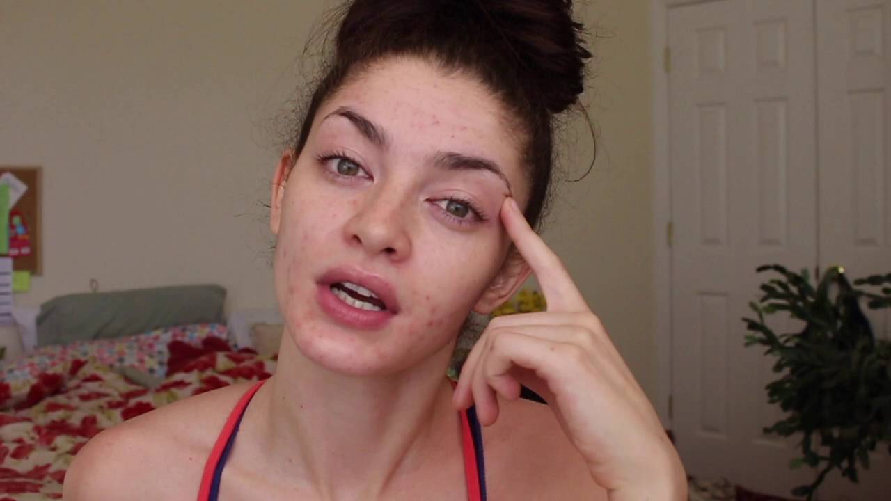 How To Have Confidence | With Acne of course