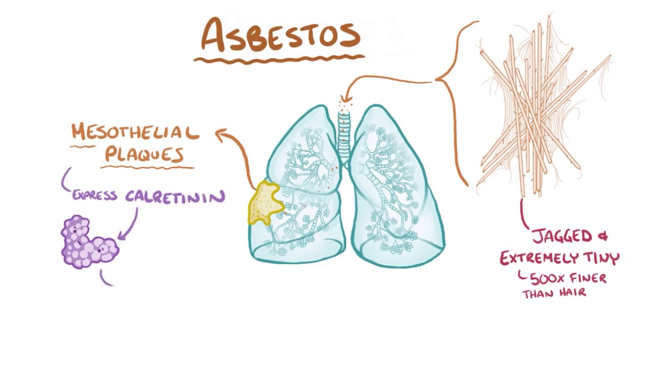 Mesothelioma   causes, symptoms, diagnosis, treatment, pathology