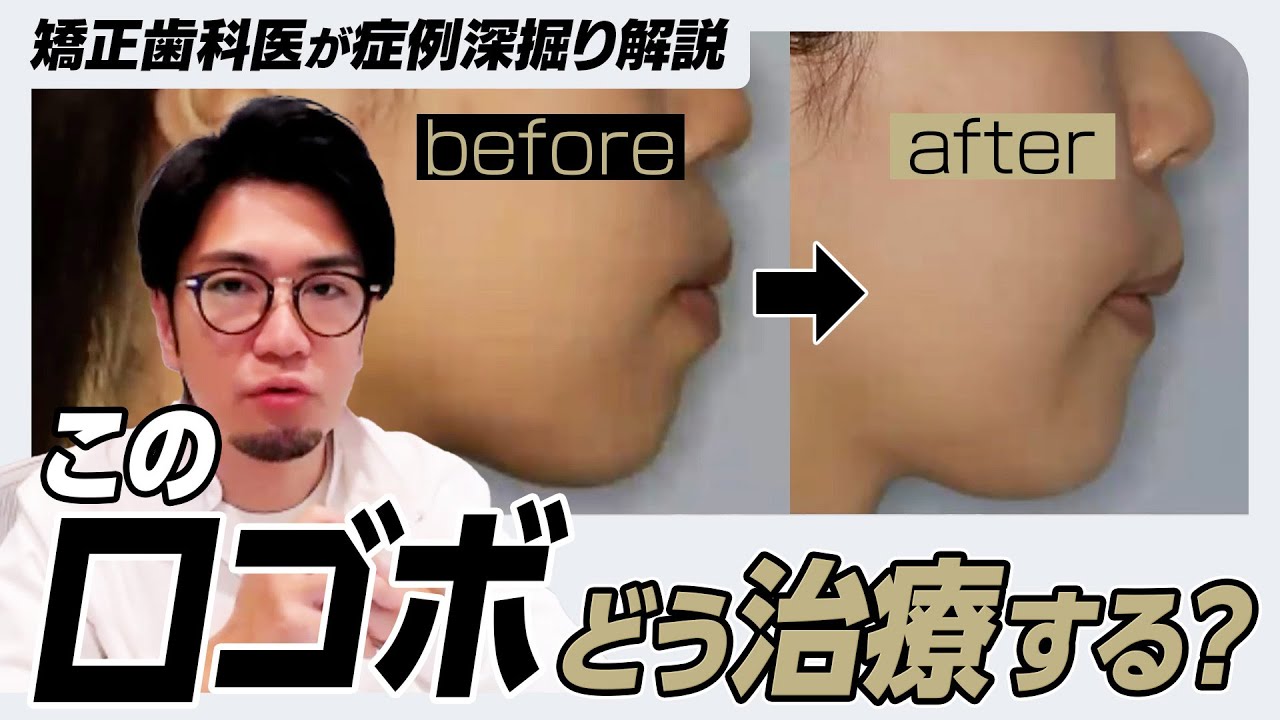 【口ゴボ矯正】矯正医がインビザライン＋抜歯でのアプローチを徹底解説
