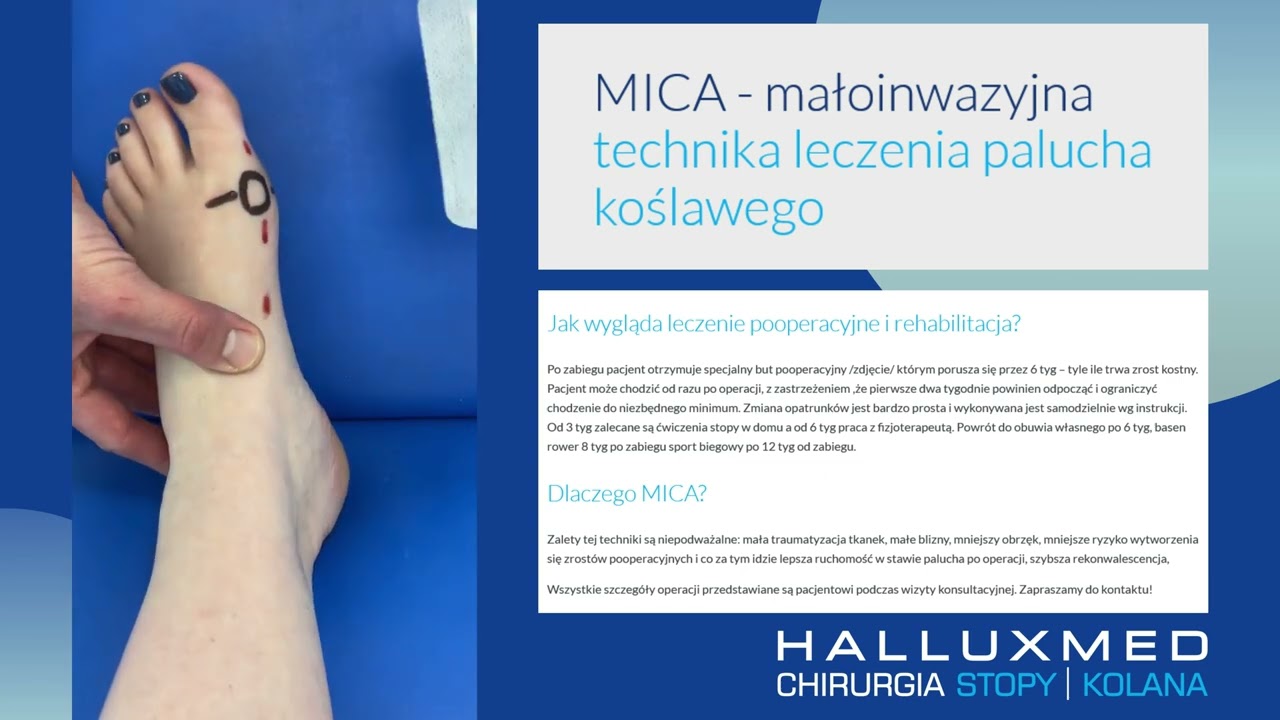 MICA - małoinwazyjna technika leczenia haluksów - opatrunek