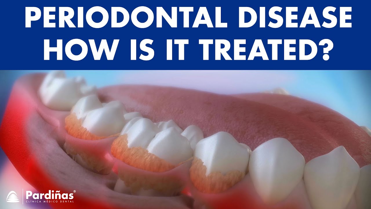 Periodontitis and its influence on health - How is periodontal disease treated? ©