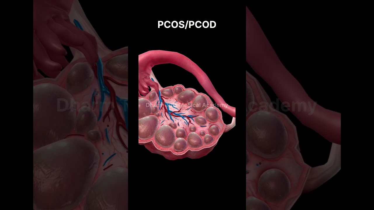 PCOS | PCOD | Ovary Disease | #pathology #3danimation