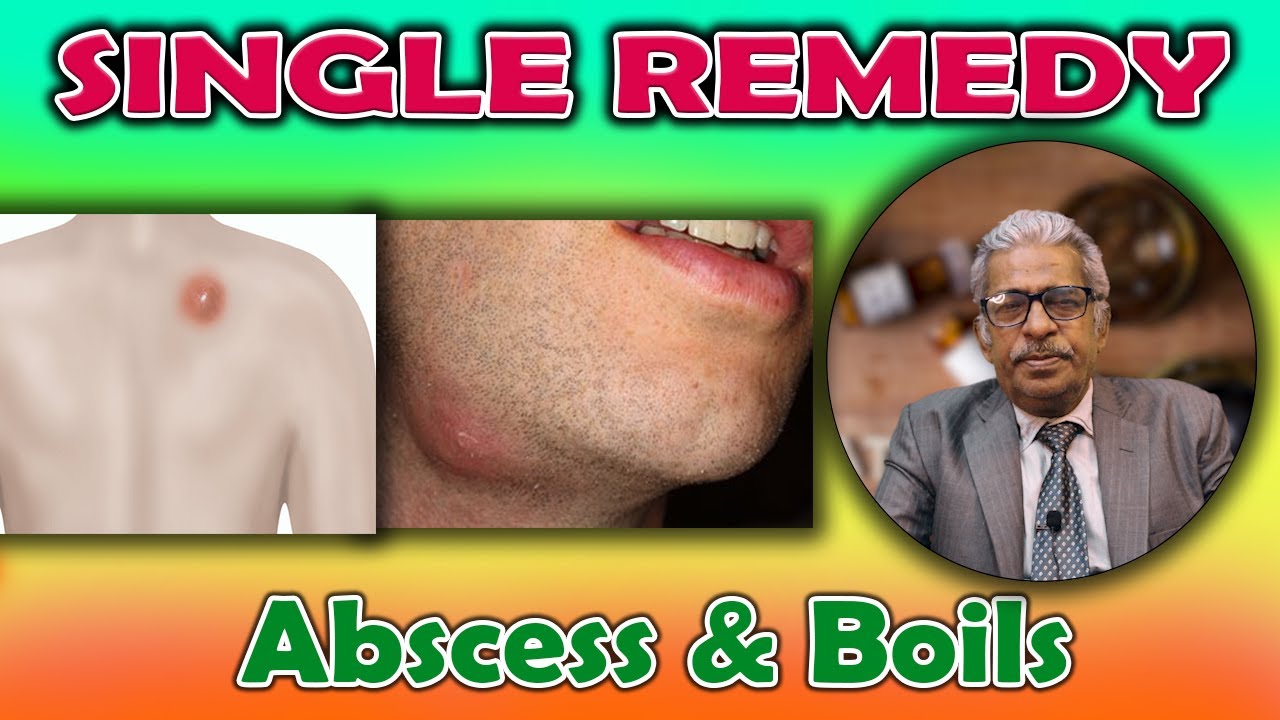 Single Remedy - Abscess & Boils -- Dr P.S. Tiwari