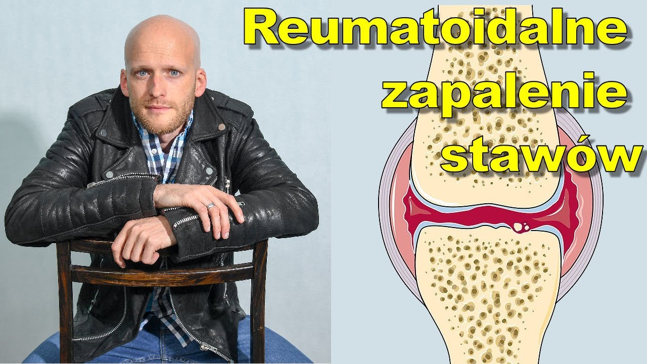 Reumatoidalne zapalenie staw&oacute;w - co robić?