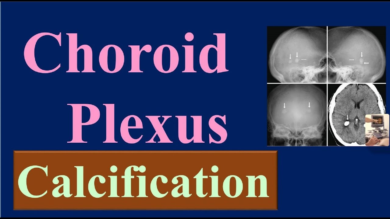 What's Hiding Behind Your Choroid Plexus Calcification Diagnosis?