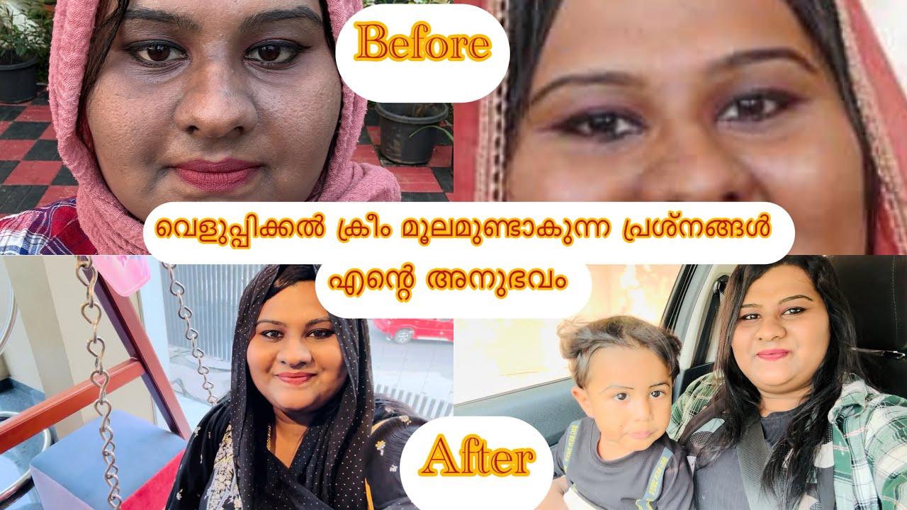 WHITENING CREAMഉപയോഗിക്കരുത് ⛔️❌ || SAY NO TO WHITENING CREAM ||