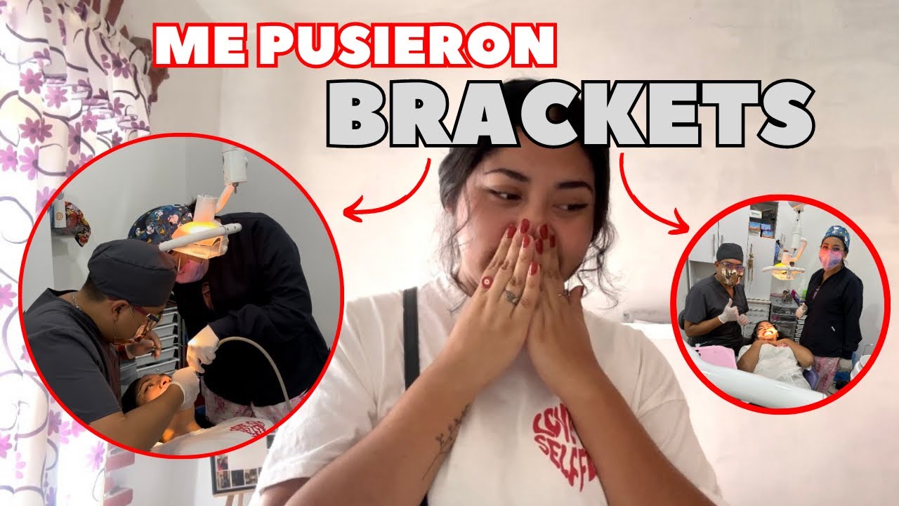 ME PUSIERON BRACKETS! 😱 me dolió? así fueron mis primeras horas