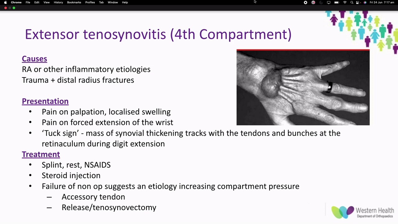 OrthoFracs - Tendinopathies of the hand and wrist by Dr Douglas Nizzero
