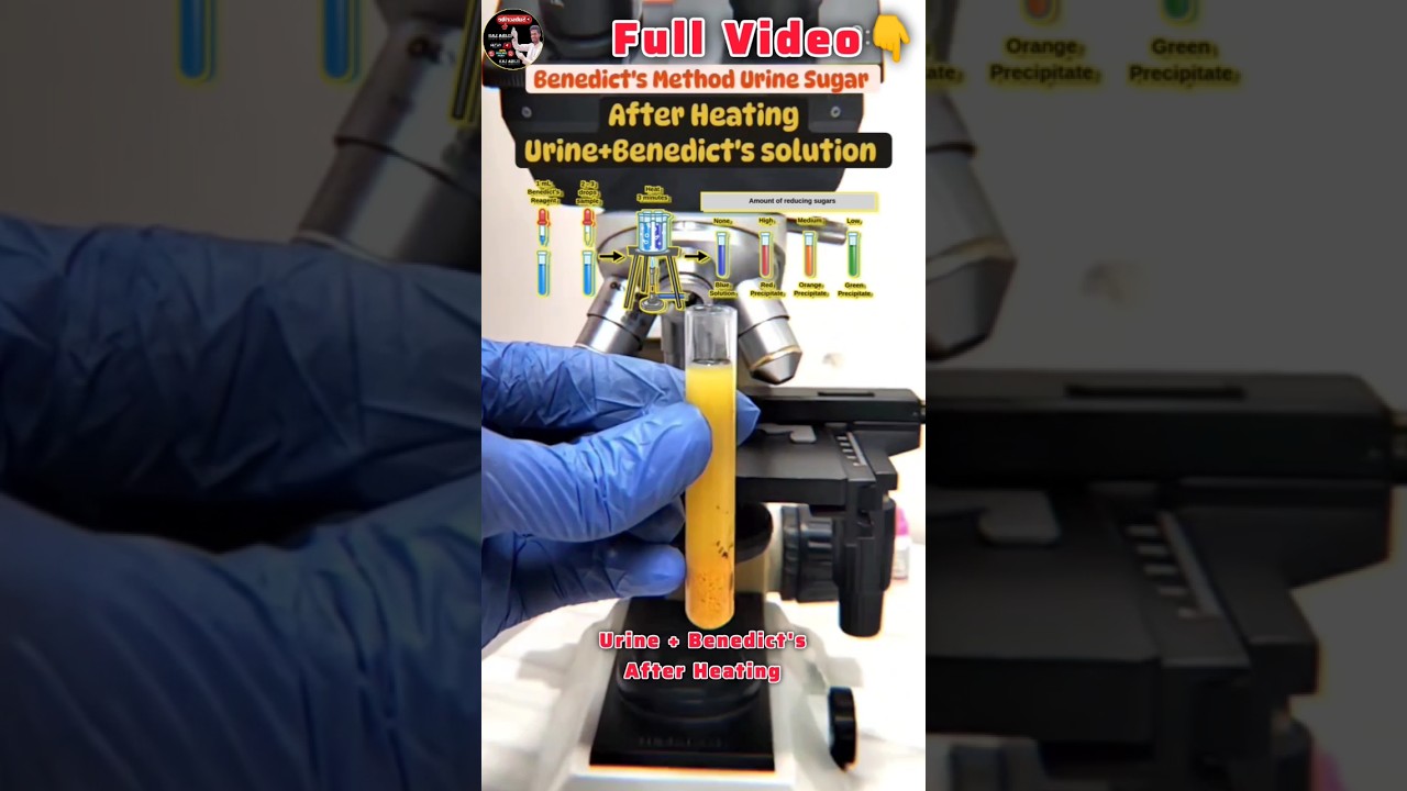 Benedict's Method Urine Sugar 😱