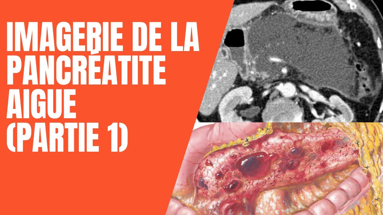 Cours médecine radiologie - Imagerie de la pancréatite aigüe (partie 1)