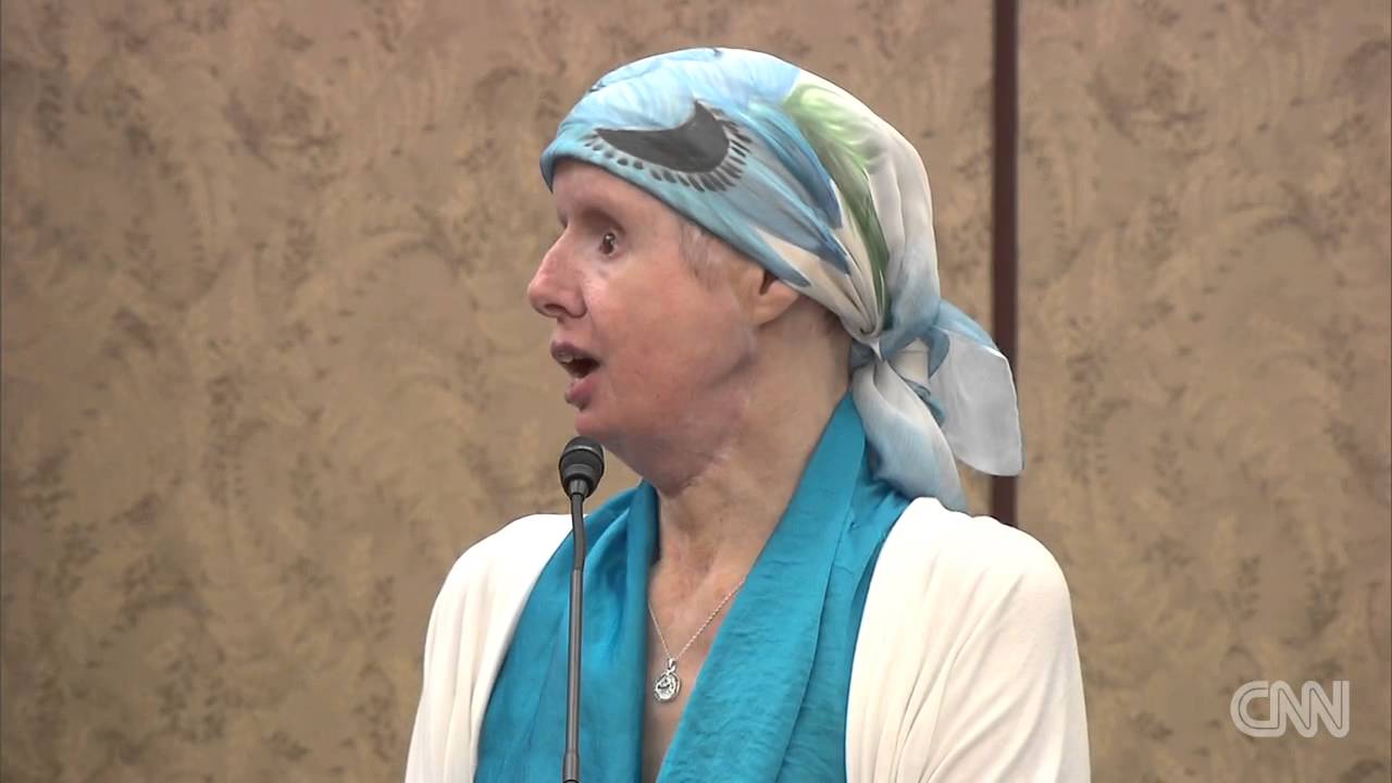 Chimp attack victim urges stricter laws