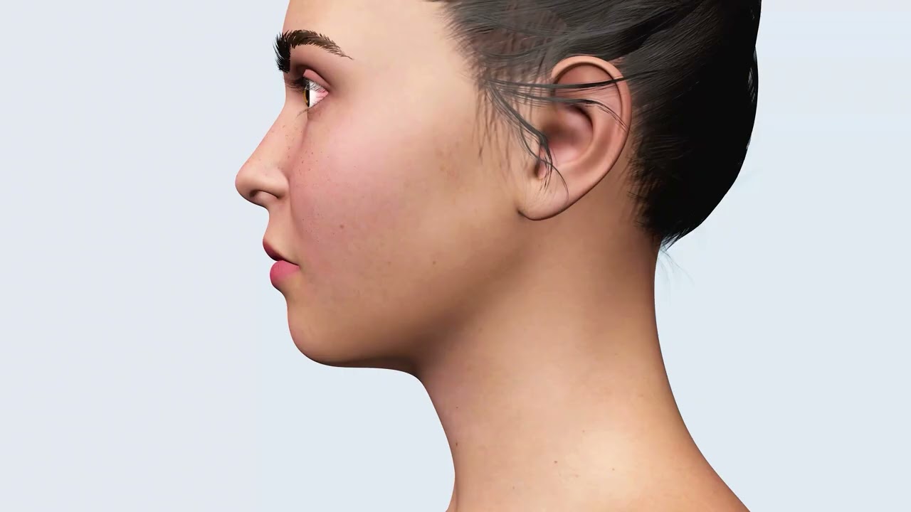 Bruxism and TMJ Disorder Explained | How Teeth Grinding Causes Jaw Pain & Disc Displacement (3D)