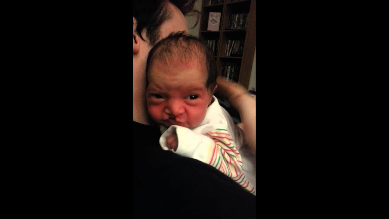 newborn with cleft lip sleeping while feeding