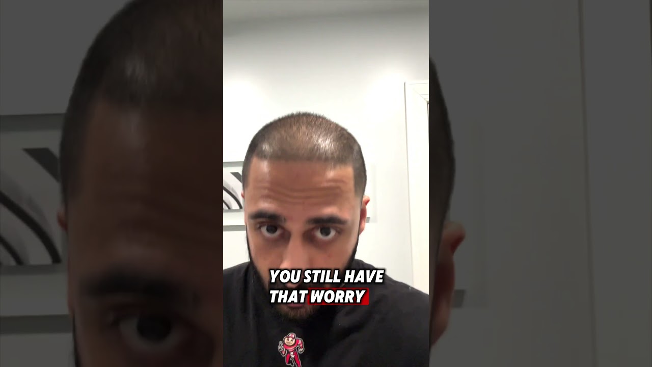 GOING BALD AFTER HAIR TRANSPLANT
