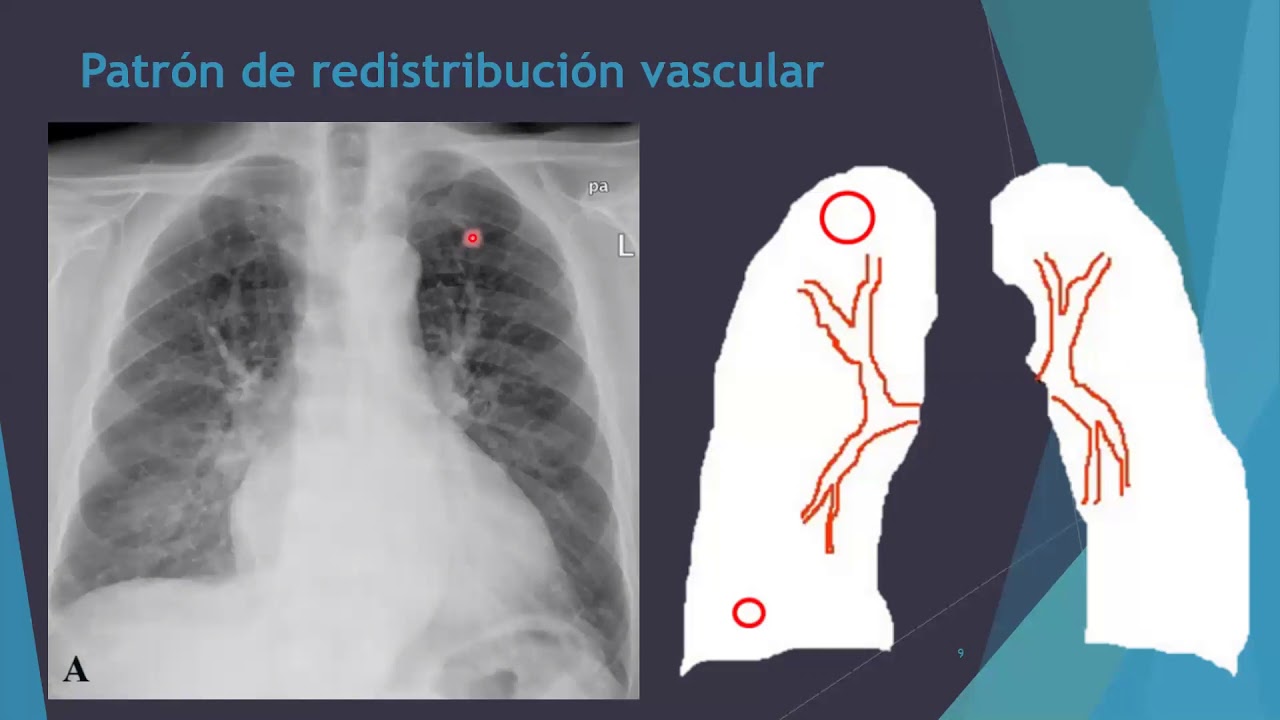 Patrones vasculares pulmonares PARTE I